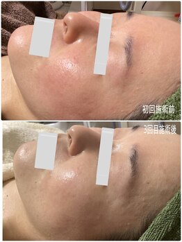 ブライトリー(Brightly)/本気の肌質改善3回目!