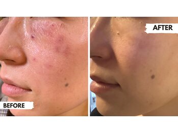 ロロメ(Rorome)/ビフォー/アフター(シミ)