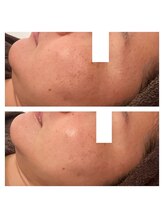 ヴィヴ コレビ(VIV COREBI)/一度で艶肌が復活♪