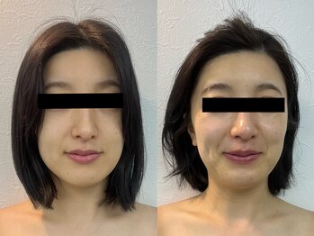 リノア 堀江(Linoa)/乾燥肌　リフトアップ