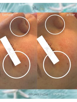 ポノ(Pono)/一回の施術効果☆