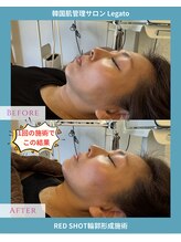 レガート(Legato)/RED SHOT脅威の輪郭形成施術☆