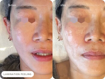 キュレイテッドスキン(CURATED SKIN)/30代.ニキビケア5回目