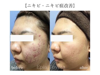 エピア 豊田店(Epia)/頑固なニキビ改善◎