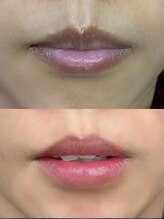 ルネル(Lunelle)/韓国式メラニンケア《唇》