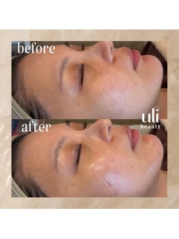 ウリ(uli beauty)/比較写真