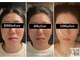 キュープ 鹿児島伊集院店(Qpu)の写真/「また来たい!」の声多数!小顔矯正も回数券でお得に◎長く通えるお気に入りサロンに是非!