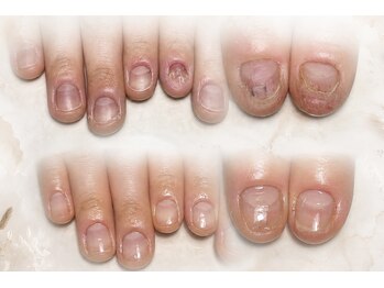 ロイネイル 札幌店(LOI nail)の写真/ジェルネイルができない方も自爪のまま縦爪にケアできる！【3ヶ月コース】で自信が持てる爪先に☆