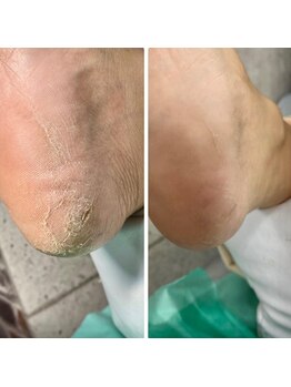 仙台巻き爪補正店/【かかとの角質ケア】