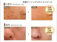 ベッラドンナ(Bella donna)/ニキビ、毛穴ケアBeforeAfter