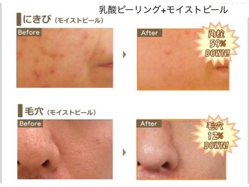 ベッラドンナ(Bella donna)/ニキビ、毛穴ケアBeforeAfter