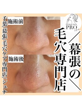 シュナ(syuna)/毛穴エステでお肌綺麗に