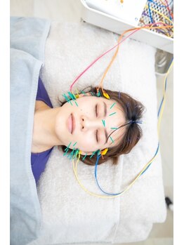 シナジープラス 水前寺店(SYNERGY+)/《むくみ撃退》プレミアム美容鍼