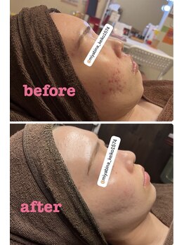 雅菜(miyabina)/ニキビケア　before→after