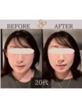 チョコバリ 錦糸町店(chocobari)/小顔×リフトアップ(美容鍼)20代