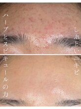 ミハン ボーテ(mihan.beaute)/【ニキビ・赤み】