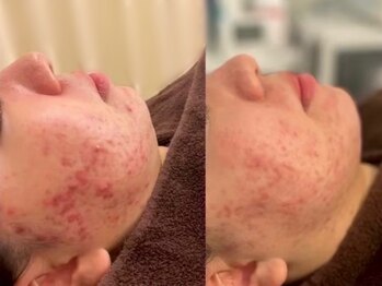 アンズ(ANZU.)の写真/【つるんと素肌】肌の変化を感じるハーブピーリング♪