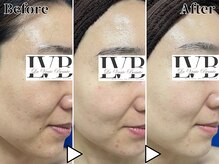 ラヴレボーテ(La Vraie Beaute)/30代・ニキビ・改善期間3ヶ月