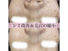 ラエッセ(LAESSE)/大人気☆ハーブピーリング