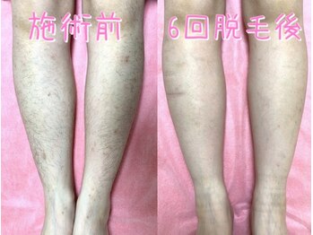 脱毛 フェイシャルサロン 光/脱毛のビフォーアフター