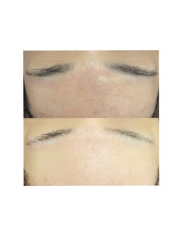 チェルト 鈴鹿店(CERTO)/ハーブピーリングで肌質改善☆