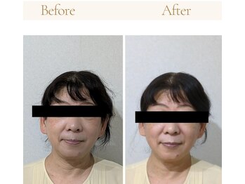 ミヤビ(miyabi)/小顔矯正