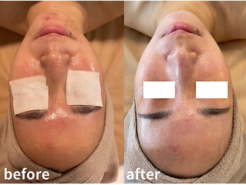 エヴァル 久留米店(ewalu)/LDMマシン施術