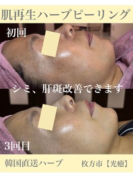光癒(コウユ)/3回Before.After