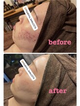 雅菜(miyabina)/赤み・肌荒れ跡改善！！