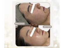 大人ニキビでお悩みでしたがホームケア+サロンケア月1～2を継続