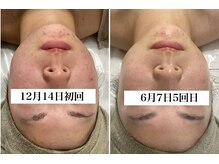 ホリシア 博多(HORISHIA)/ハーブピーリング/ニキビケア