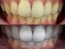 歯のクリーニング＆効果2倍高密着ペーストで着色汚れを徹底除去