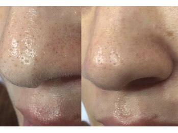 クラスペディア 嘉島店/毛穴洗浄×メラトルマスクケア