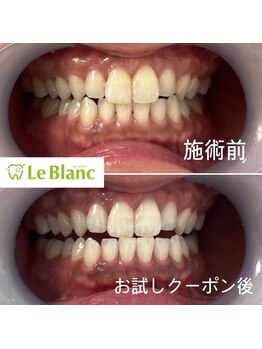 ルブラン 奈良店(Le Blanc)/黄ばみを落として白い歯に！