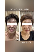 サロン ド スー(Salon de Suu)/貼る！糸美容でシワ改善！