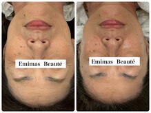 エミマス ボーテ(Emimas Beaute’)/６０代 毛穴洗浄＆幹細胞３回目