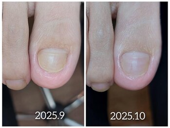 【自爪育成】伸びない爪サポート