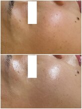 リノ(lino)/毛穴のザラつき、くすみオフ