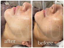 カフー(KAFUU)/クリスティーナ/シミ/毛穴/赤み