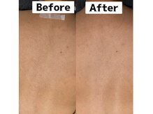 ビューティーデザインアウル(BEAUTY DESIGN OWL)/背中脱毛Before→after