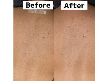 ビューティーデザインアウル(BEAUTY DESIGN OWL)/背中脱毛Before→after