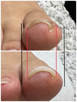 シーディーエム(cdm)/巻き爪ケア