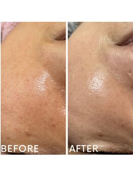 ランプシー(Lampsi)/フェイスWaxで毛穴を小さく！