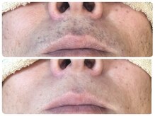 脱毛サロン ベル(Bell)/大人気◎【ヒゲ＆顔脱毛】