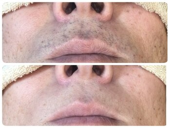 脱毛サロン ベル(Bell)/大人気◎【ヒゲ＆顔脱毛】