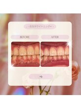プラスビーセルフ(+b self)/ホワイトニングビフォーアフター
