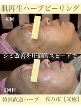 光癒(コウユ)/2回Before.After