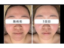 スリーメイ(3mey)/高周波×脂肪燃焼剤