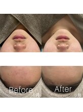 プララン 京都桂店(Plaran)/乳酸菌ピーリング