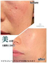 シャルム(charme)/若よもぎ蒸しビフォーアフター